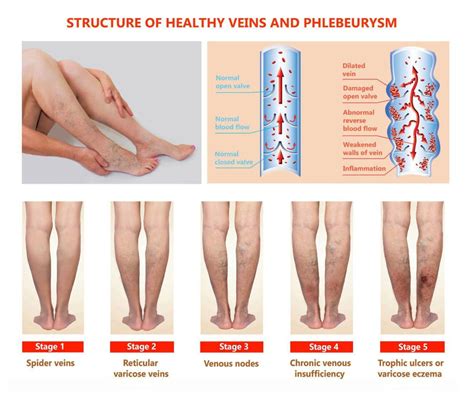 vein compression test|chronic venous insufficiency physical exam.